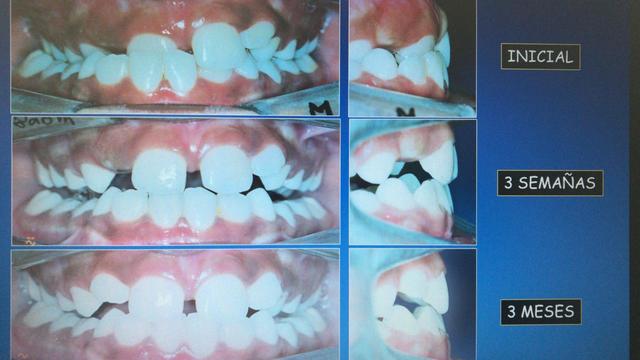 “La nueva alternativa en ortodoncia mínimamente invasiva, con aplicación de Mini Tubos, Flow Jac System”