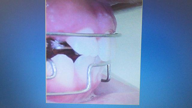 “La nueva alternativa en ortodoncia mínimamente invasiva, con aplicación de Mini Tubos, Flow Jac System”